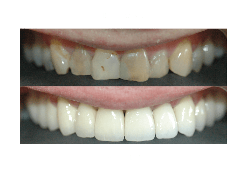 vmk/pmf crowns dental work before and after