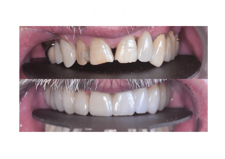 zirconium crowns with emax facings dental work before and after