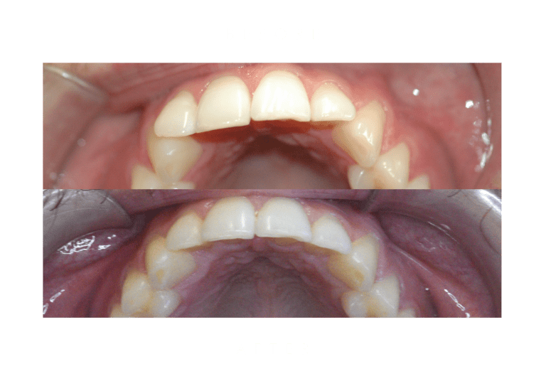 orthodontics dental work before and after