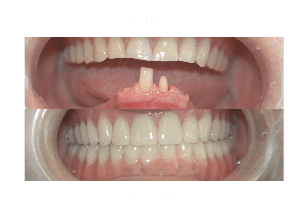 over dentures dental work before and after