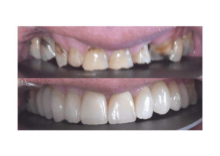zirconium crowns with emax facings dental work before and after
