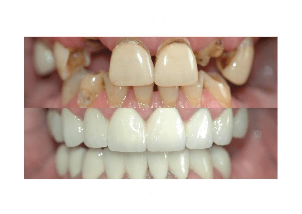 vmk/pmf crowns dental work before and after
