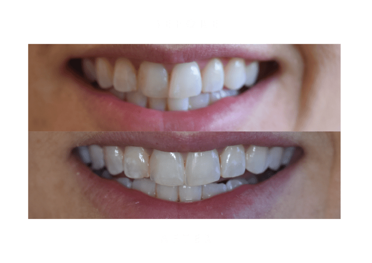 invisalign dental work before and after