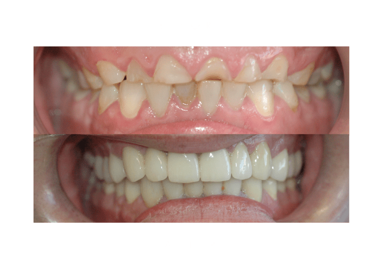 attrition dental work before and after