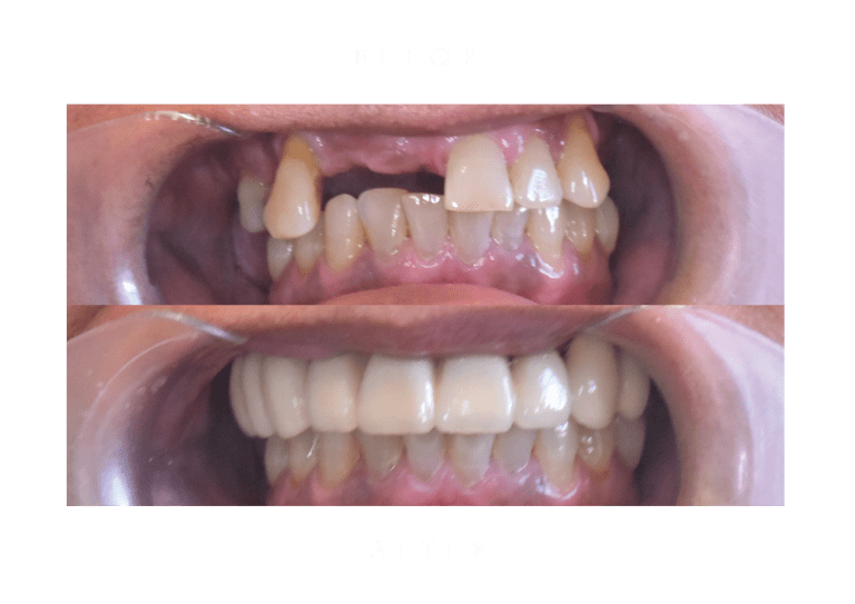 bridges dental work before and after