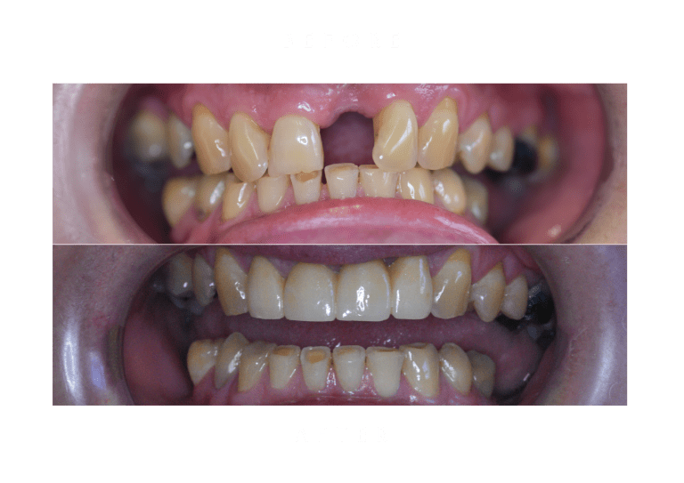 bridges dental work before and after
