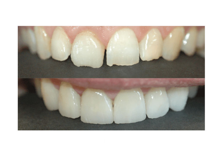 porcelain veneers dental work before and after