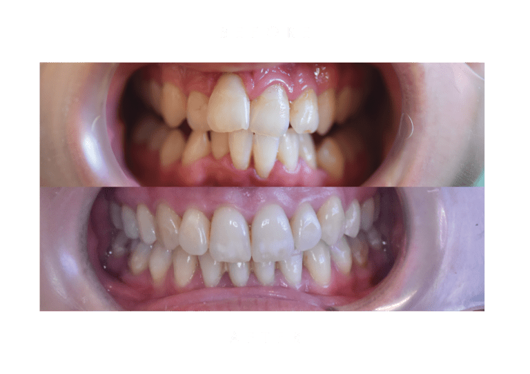 invisalign dental work before and after
