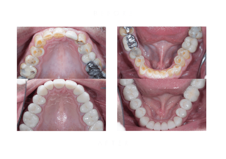 attrition dental work before and after